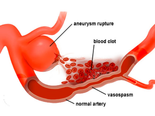 Aneurysms