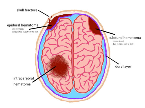 Brain hemorrhage treatment
