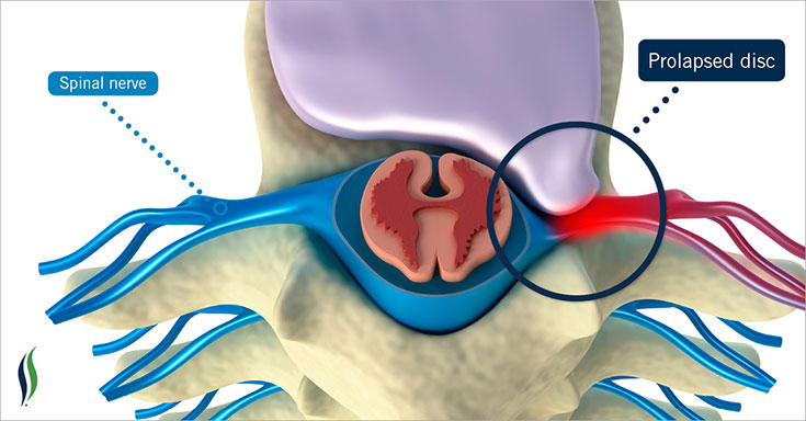 Disc injury and prolapse treatment