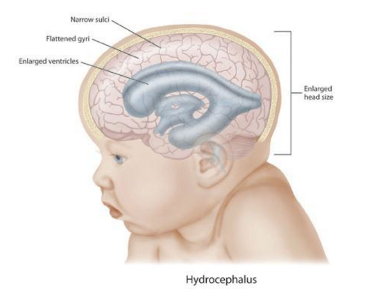 Understanding hydrocephalus and specialist care
