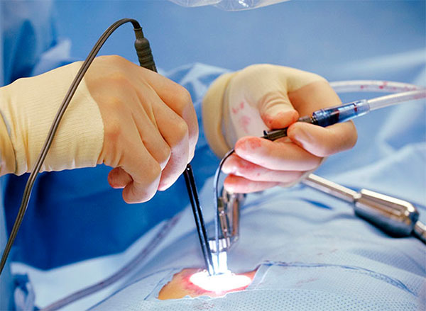 Micro invasive neuro surgery
