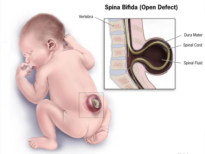 Spina Bifida