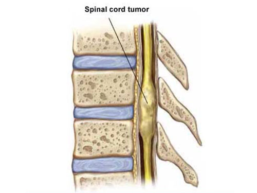 Spinal cord tumors treatment
