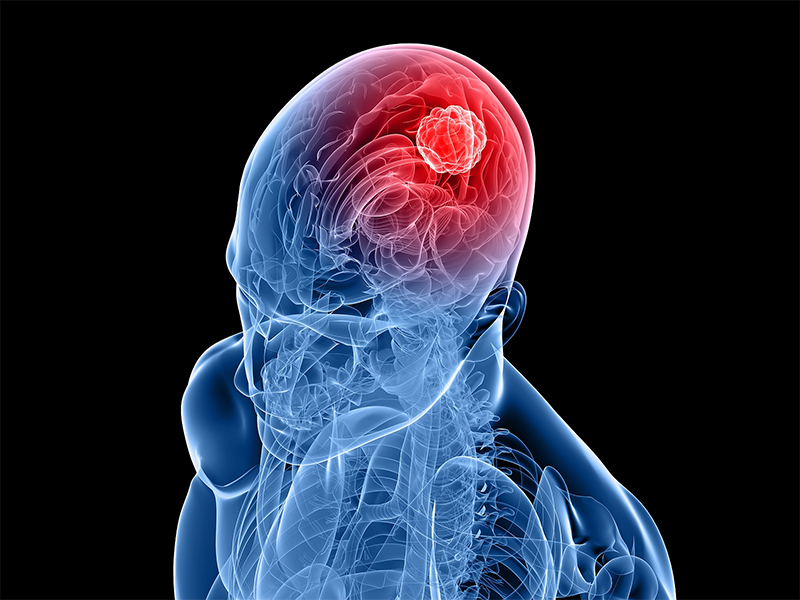 Brain tumors treatment
